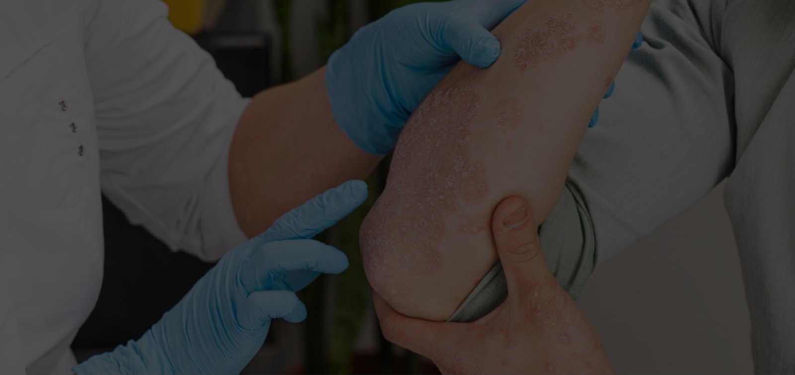 Chronic Skin Disease Psoriasis